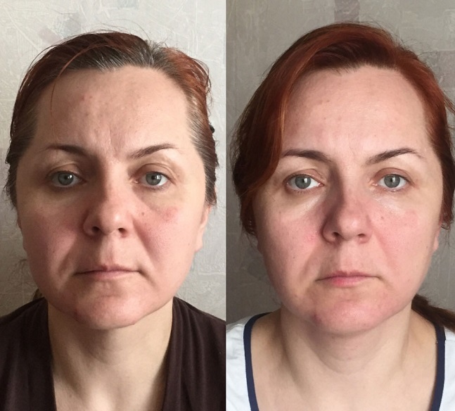 Фото до и после второй процедуры сплит-массажа